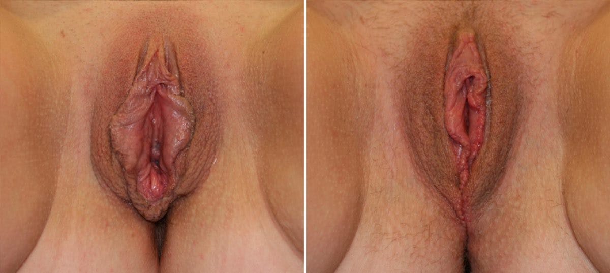Vaginoplasty Before & After Photo - Patient 54882746 - Image 1