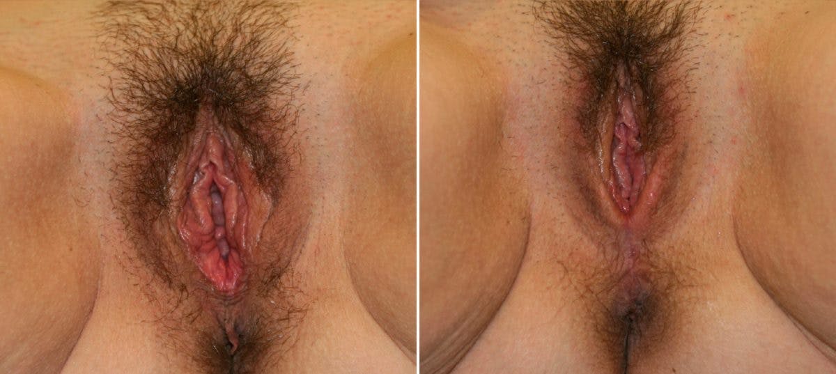 Vaginoplasty Before & After Gallery - Patient 54882751 - Image 1