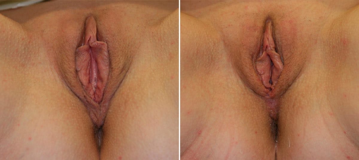 Vaginoplasty Before & After Gallery - Patient 54882753 - Image 1