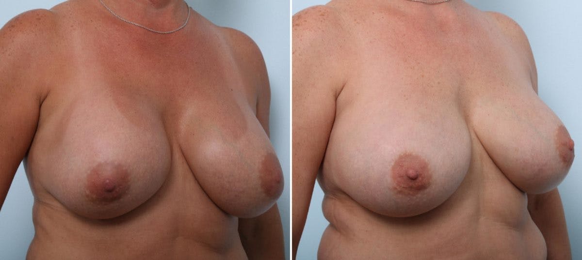 Breast Implant Exchange Before & After Gallery - Patient 54883267 - Image 3