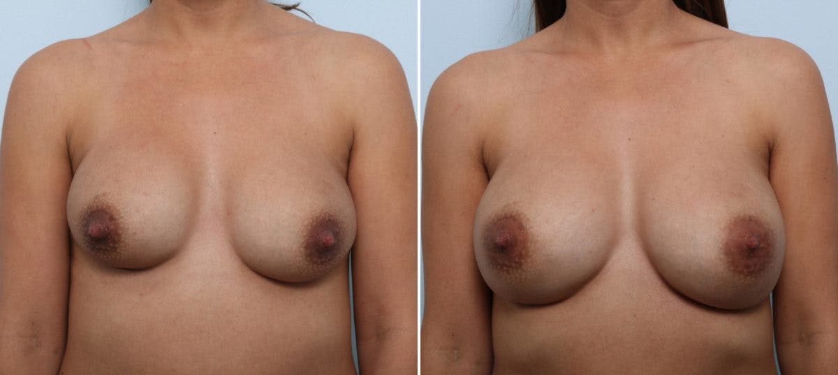 Breast Implant Exchange Before & After Gallery - Patient 54883269 - Image 1