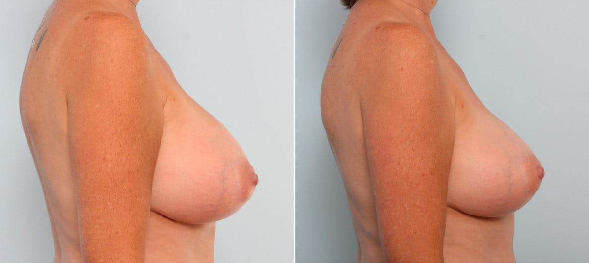 Breast Implant Exchange Before & After Gallery - Patient 54883270 - Image 2