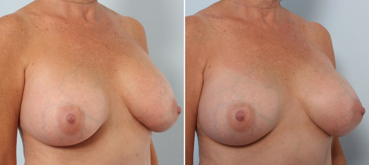 Breast Implant Exchange Before & After Gallery - Patient 54883270 - Image 3