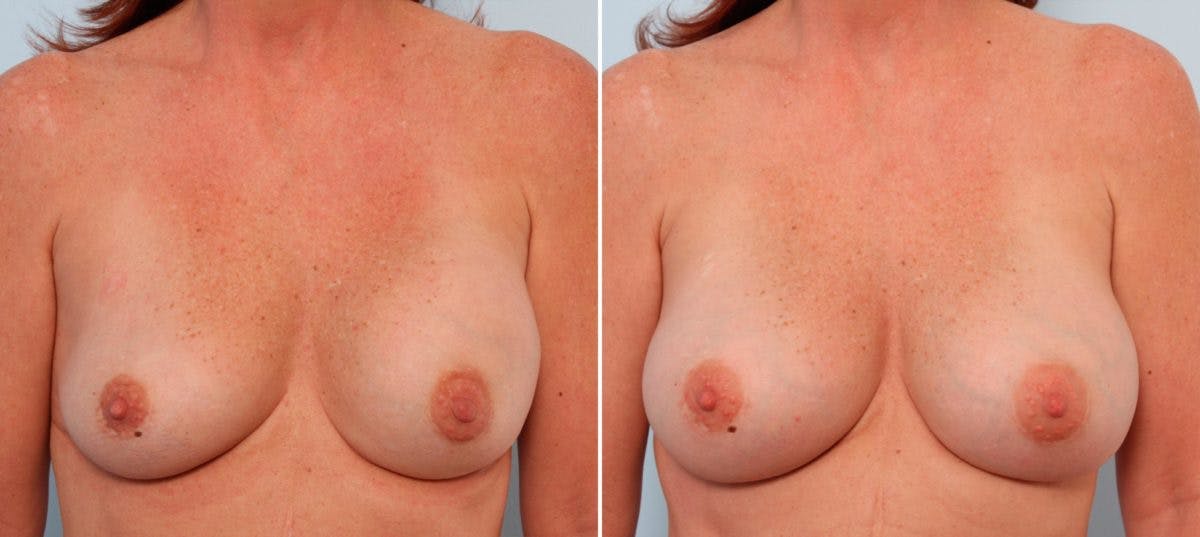 Breast Implant Exchange Before & After Gallery - Patient 54883273 - Image 1