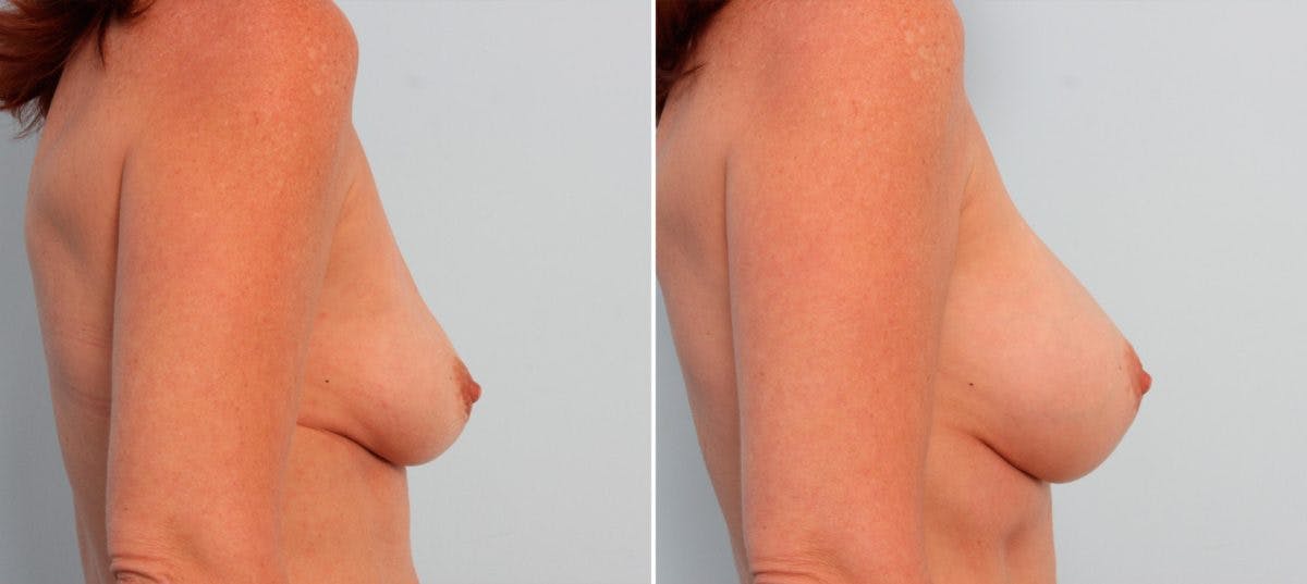 Breast Implant Exchange Before & After Gallery - Patient 54883273 - Image 2