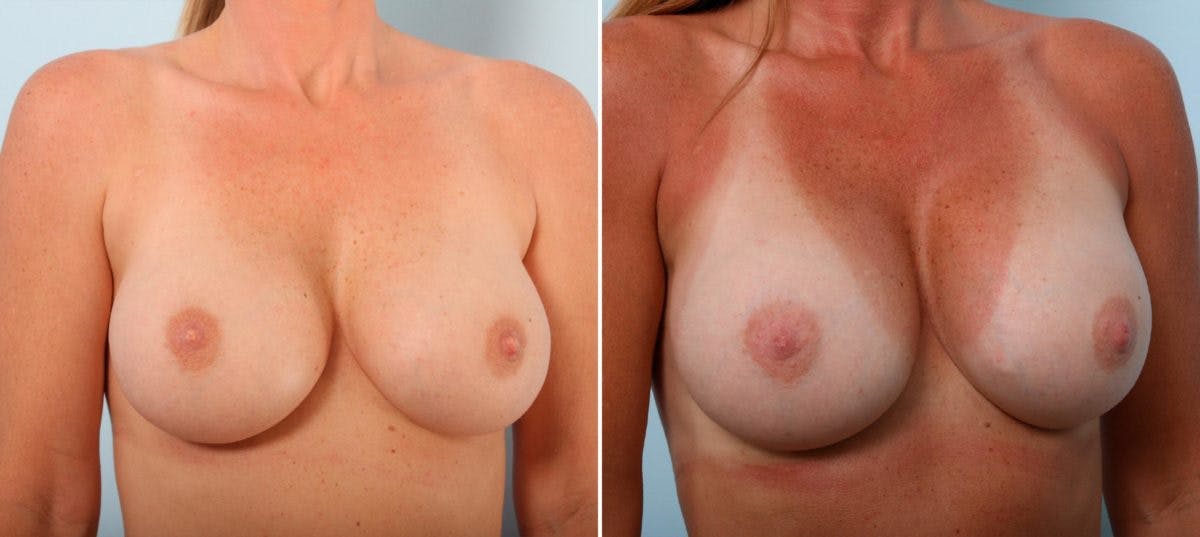 Breast Implant Exchange Before & After Gallery - Patient 54883275 - Image 3