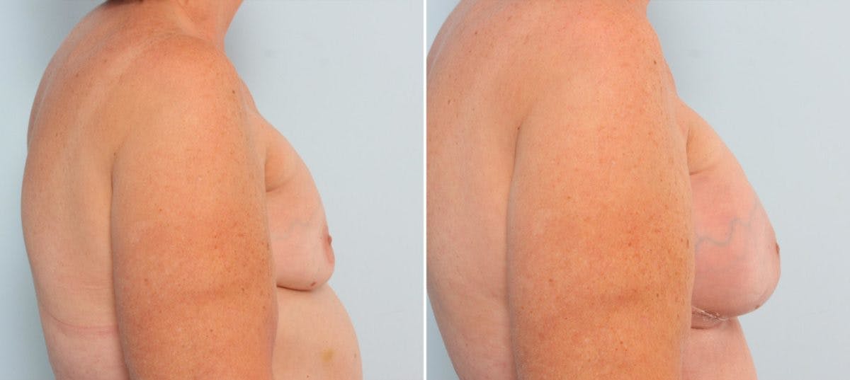 Breast Implant Exchange Before & After Gallery - Patient 54883276 - Image 2