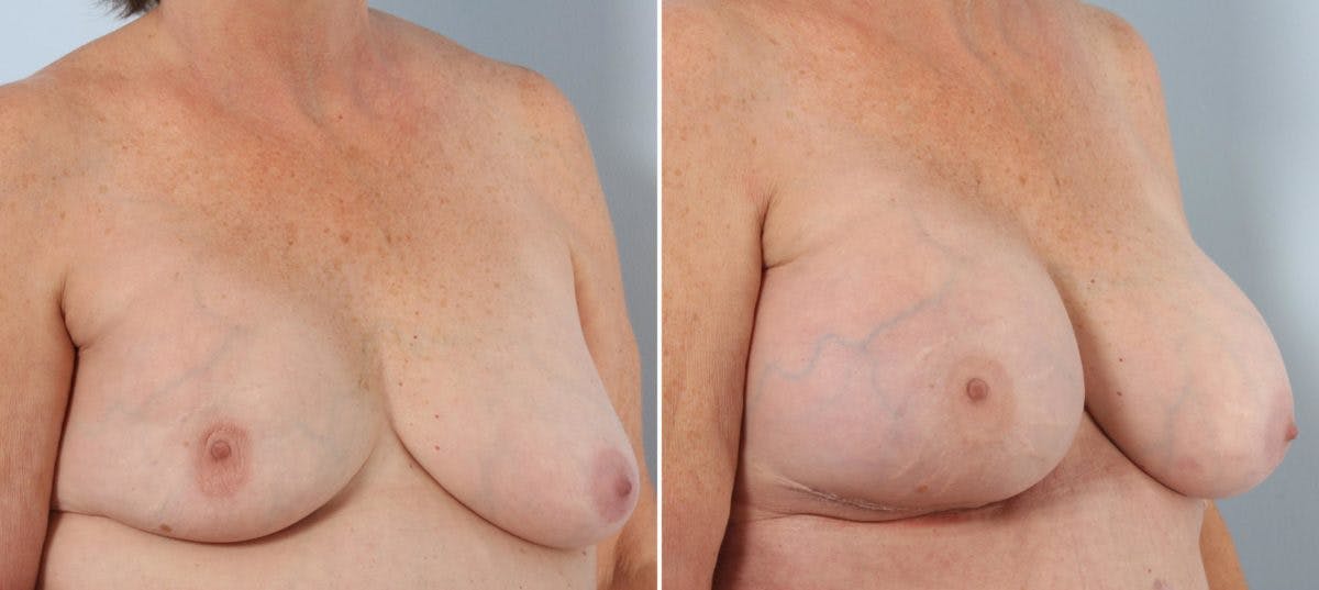 Breast Implant Exchange Before & After Gallery - Patient 54883276 - Image 3