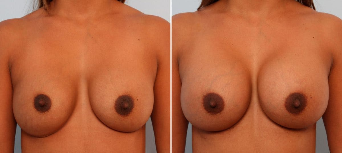 Breast Implant Exchange Before & After Gallery - Patient 54883279 - Image 1
