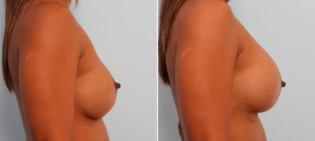 Breast Implant Exchange Before & After Gallery - Patient 54883279 - Image 2
