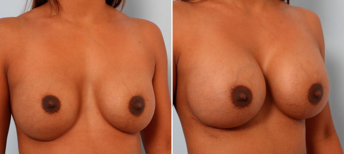 Breast Implant Exchange Before & After Gallery - Patient 54883279 - Image 3