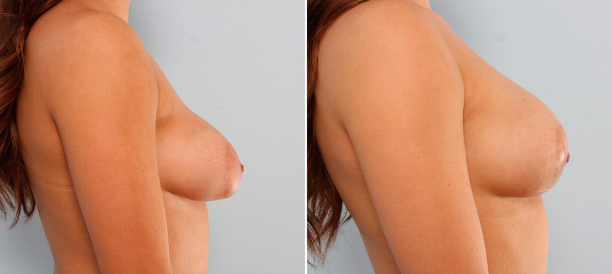 Breast Implant Exchange Before & After Photo - Patient 54883283 - Image 2