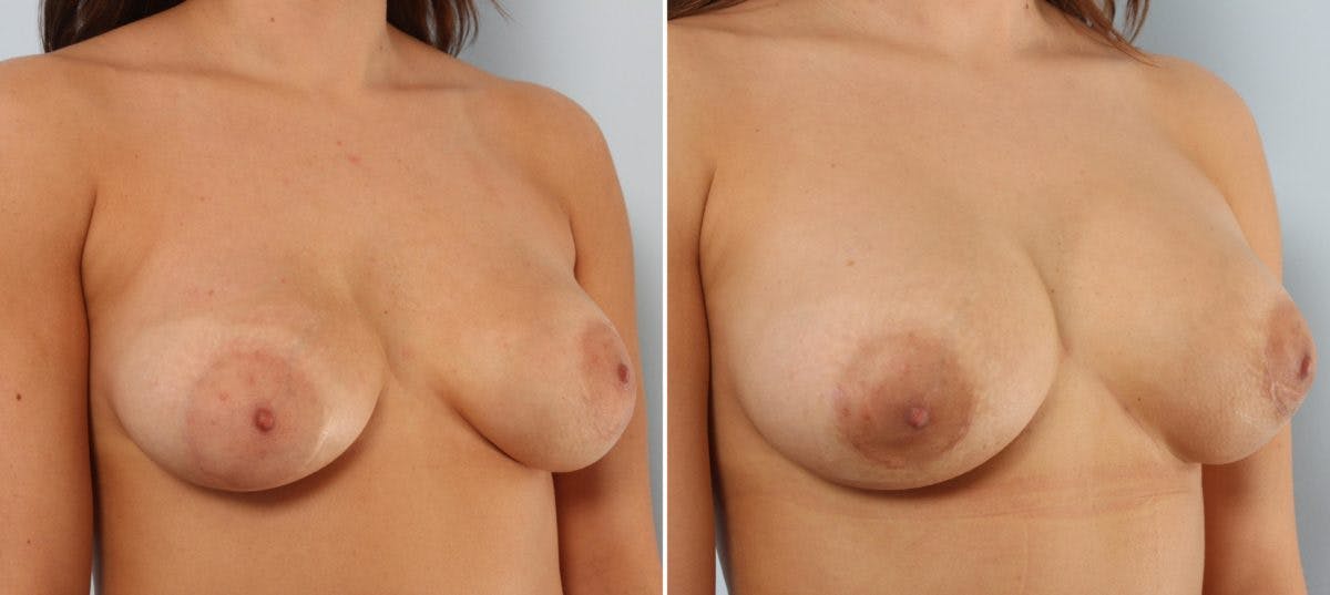 Breast Implant Exchange Before & After Gallery - Patient 54883283 - Image 3