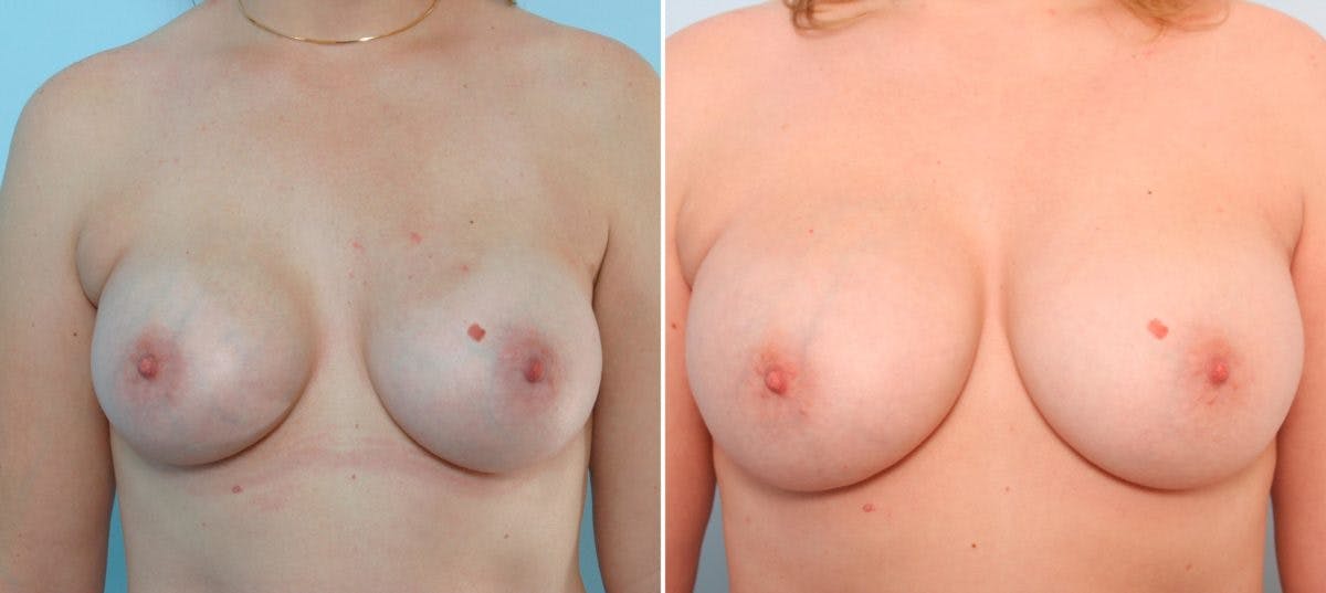 Breast Implant Exchange Before & After Gallery - Patient 54883284 - Image 1