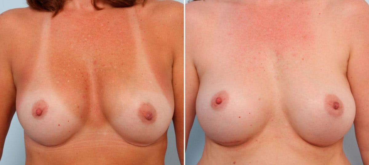 Breast Implant Exchange Before & After Photo - Patient 54883287 - Image 1