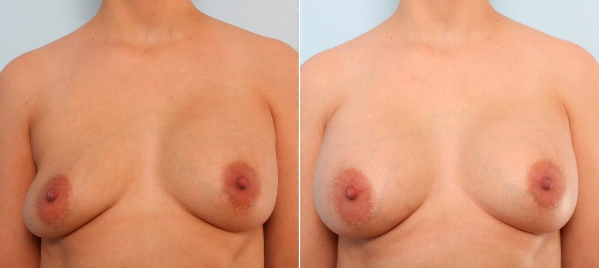 Breast Implant Exchange Before & After Gallery - Patient 54883289 - Image 1