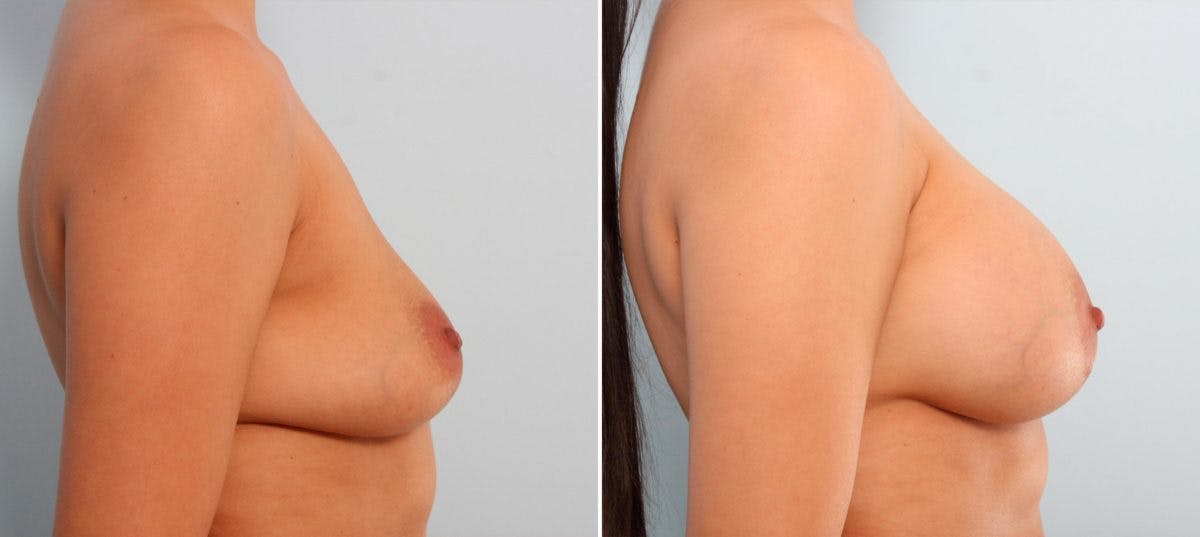 Breast Implant Exchange Before & After Gallery - Patient 54883289 - Image 2