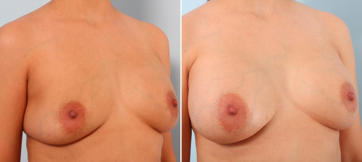 Breast Implant Exchange Before & After Gallery - Patient 54883289 - Image 3