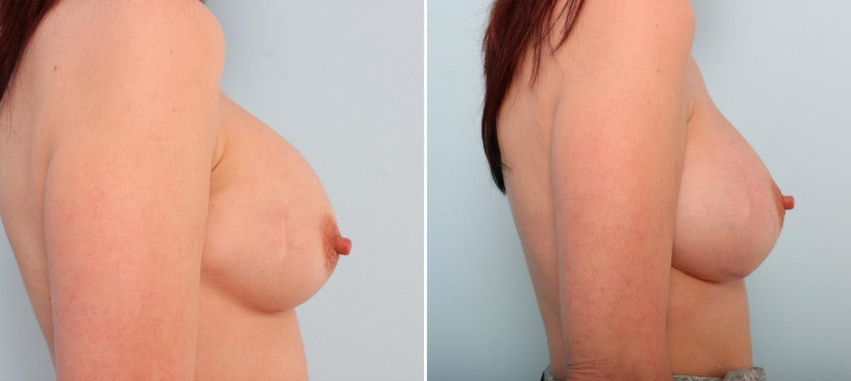 Breast Implant Exchange Before & After Gallery - Patient 54883291 - Image 2