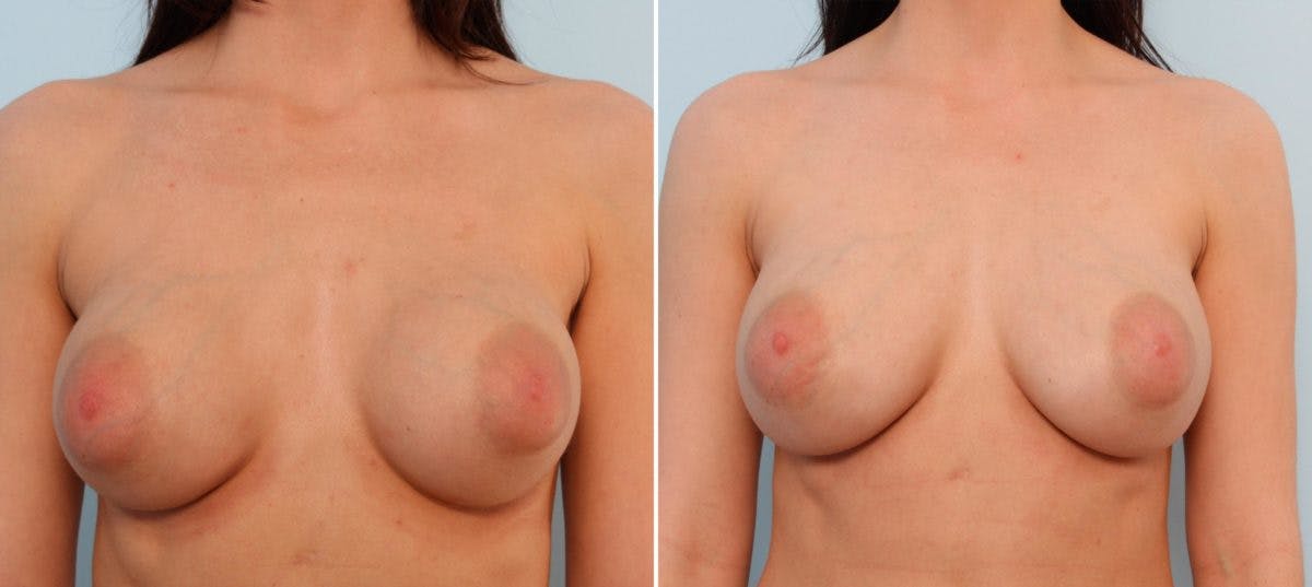 Breast Implant Exchange Before & After Gallery - Patient 54883293 - Image 1