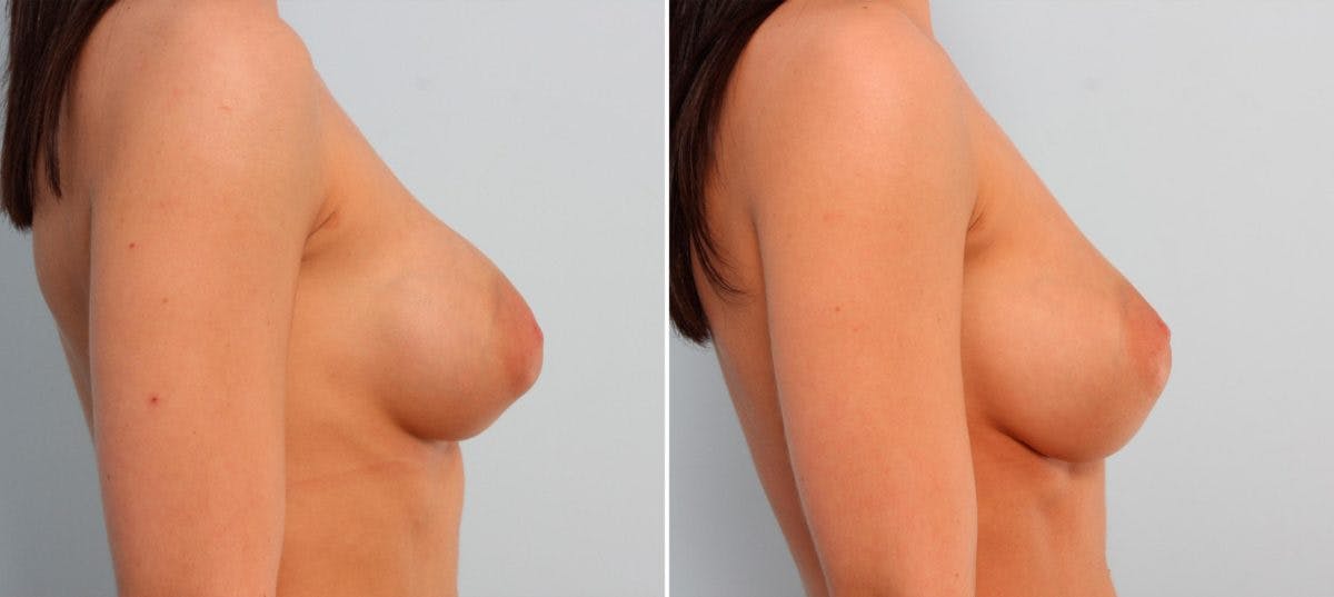 Breast Implant Exchange Before & After Gallery - Patient 54883293 - Image 2