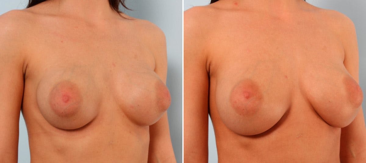 Breast Implant Exchange Before & After Gallery - Patient 54883293 - Image 3
