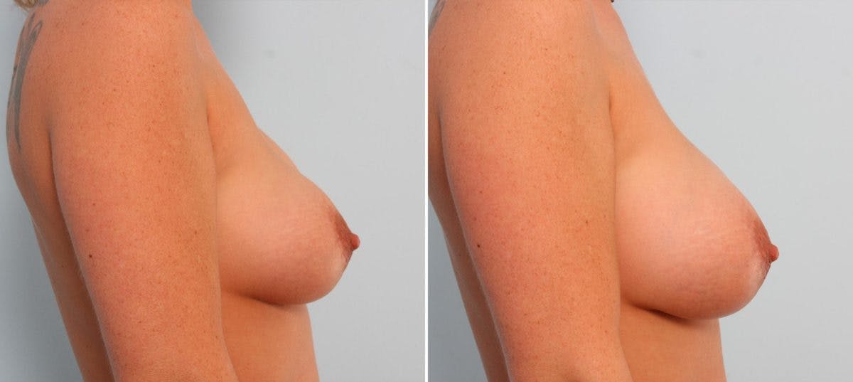 Breast Implant Exchange Before & After Photo - Patient 54883298 - Image 2