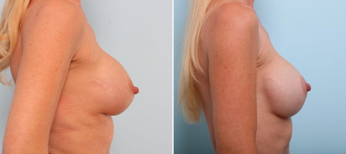 Breast Implant Exchange Before & After Gallery - Patient 54883301 - Image 2