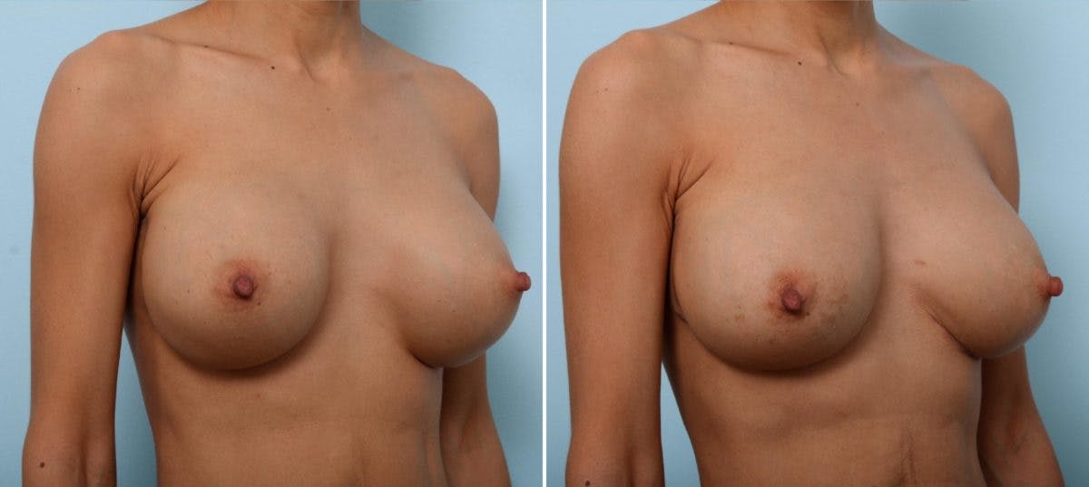 Breast Implant Exchange Before & After Gallery - Patient 54883302 - Image 3
