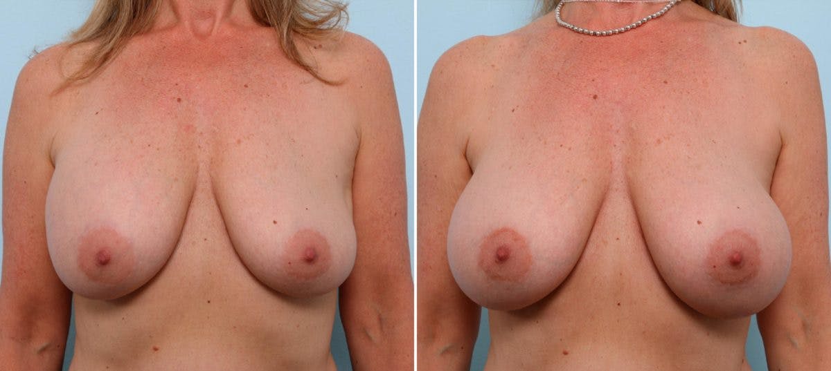 Breast Implant Exchange Before & After Gallery - Patient 54883305 - Image 1