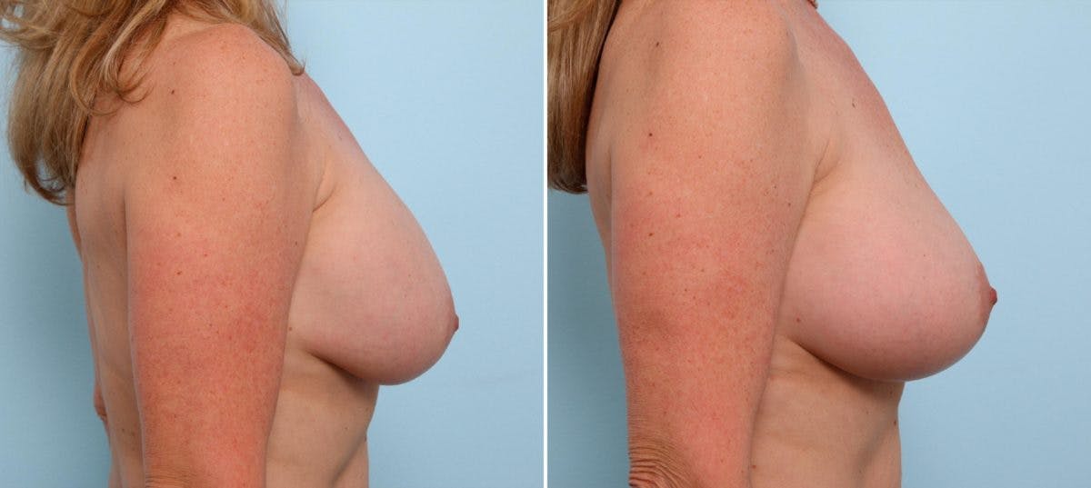 Breast Implant Exchange Before & After Gallery - Patient 54883305 - Image 2