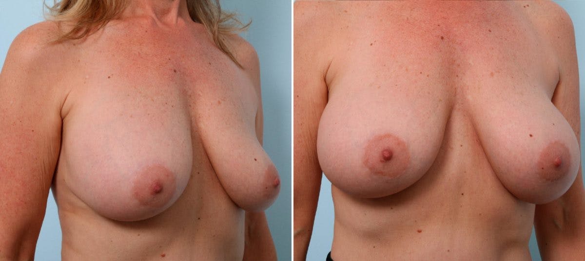 Breast Implant Exchange Before & After Gallery - Patient 54883305 - Image 3