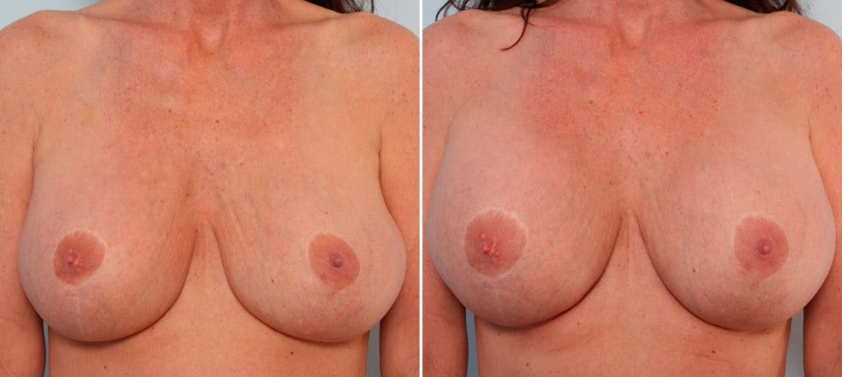 Breast Implant Exchange Before & After Gallery - Patient 54883307 - Image 1