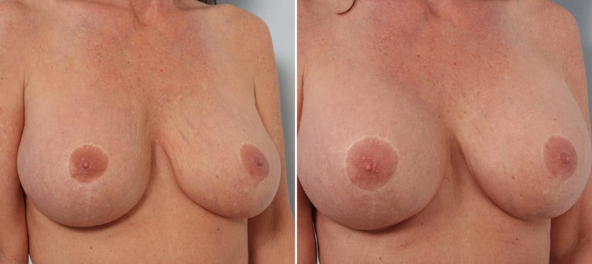 Breast Implant Exchange Before & After Gallery - Patient 54883307 - Image 3