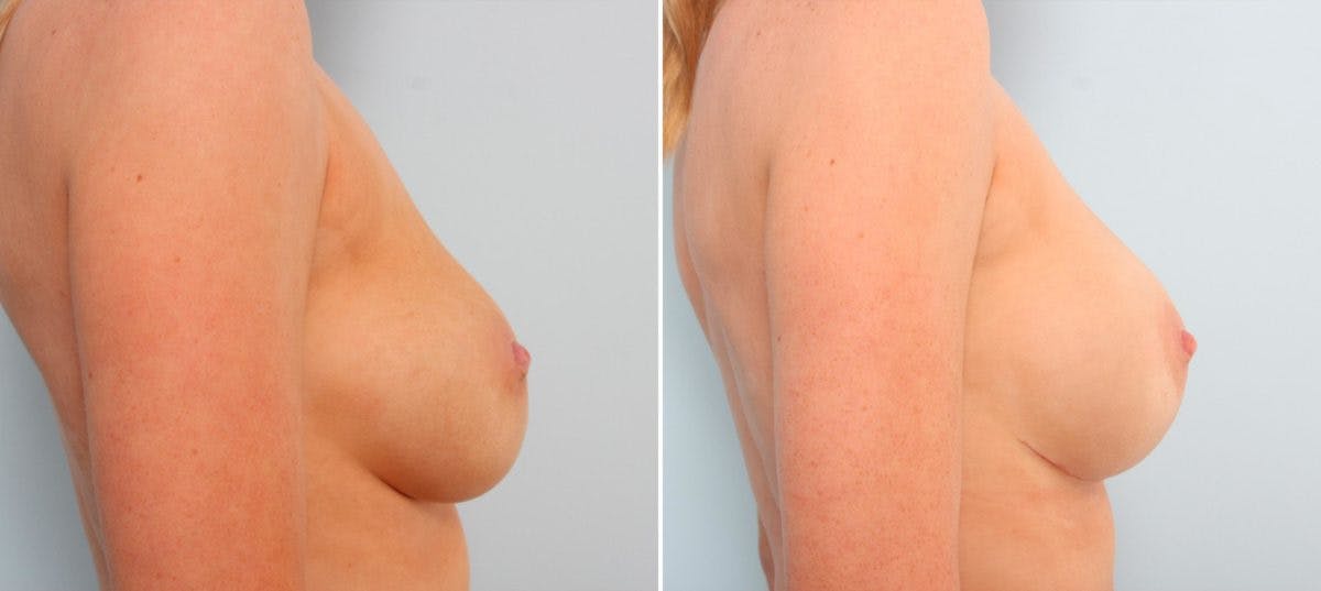 Breast Implant Exchange Before & After Gallery - Patient 54883308 - Image 2