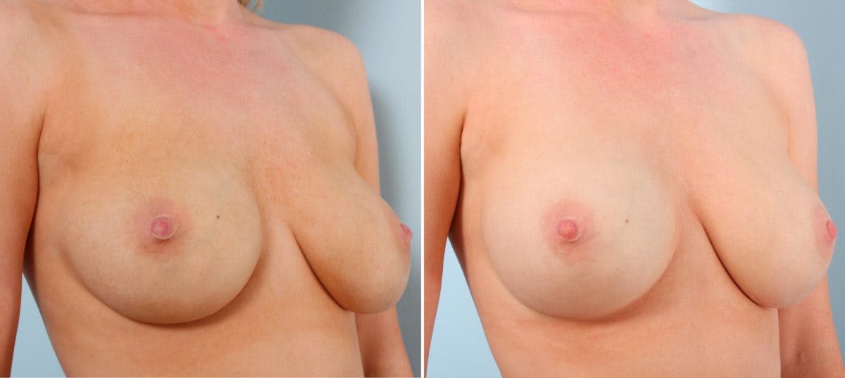 Breast Implant Exchange Before & After Gallery - Patient 54883308 - Image 3