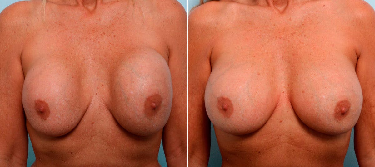 Breast Revision with Strattice Before & After Photo - Patient 54883342 - Image 1
