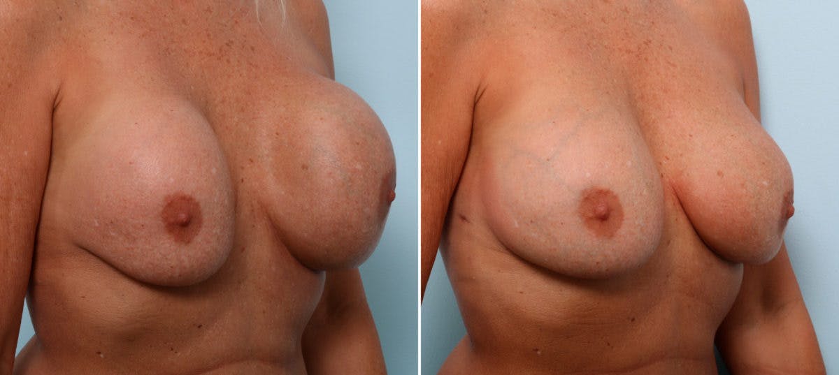 Breast Revision with Strattice Before & After Photo - Patient 54883342 - Image 2