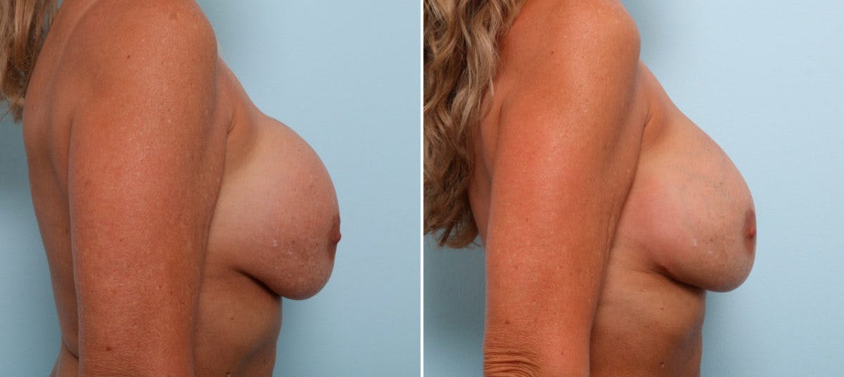 Breast Revision with Strattice Before & After Photo - Patient 54883342 - Image 3