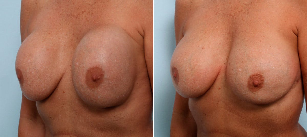 Breast Revision with Strattice Before & After Photo - Patient 54883342 - Image 4