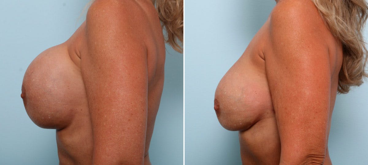 Breast Revision with Strattice Before & After Photo - Patient 54883342 - Image 5