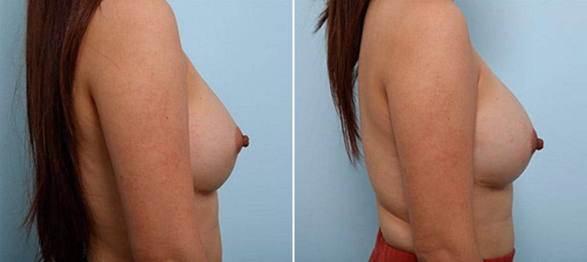Breast Revision with Strattice Before & After Photo - Patient 54883344 - Image 3