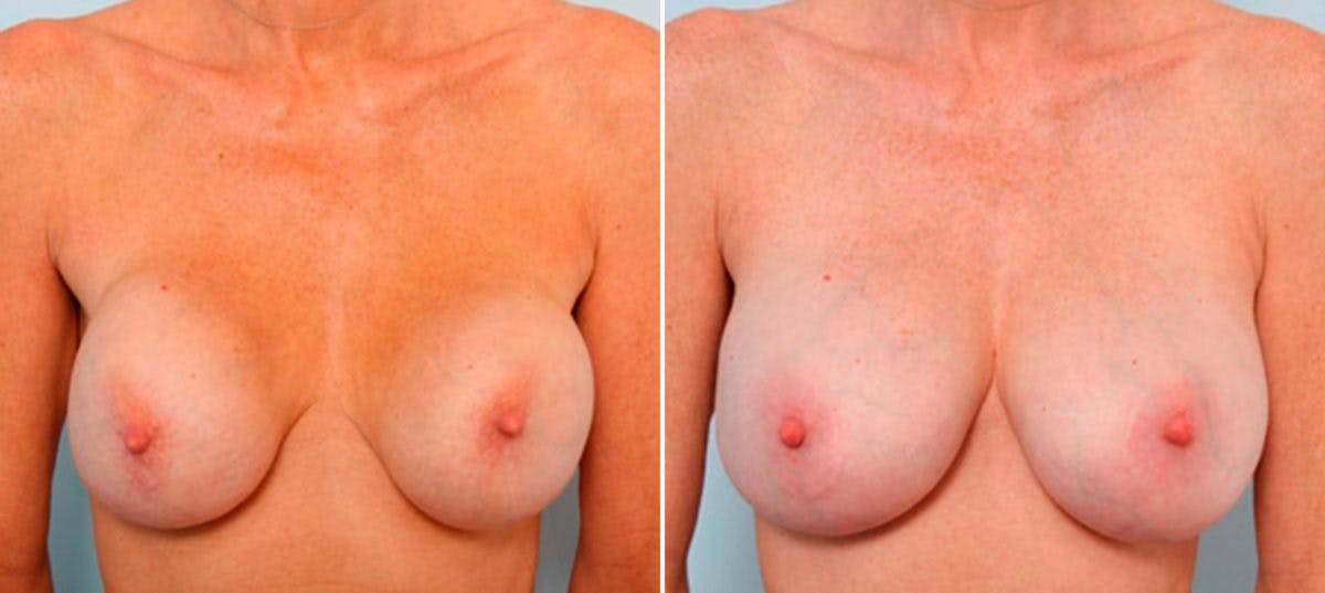 Breast Revision with Strattice Before & After Photo - Patient 54883347 - Image 1