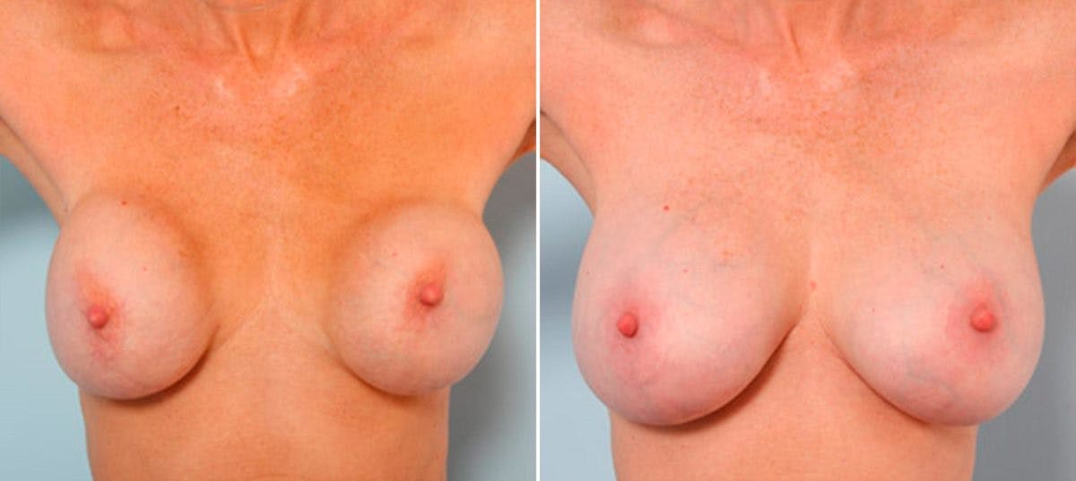 Breast Revision with Strattice Before & After Photo - Patient 54883347 - Image 2