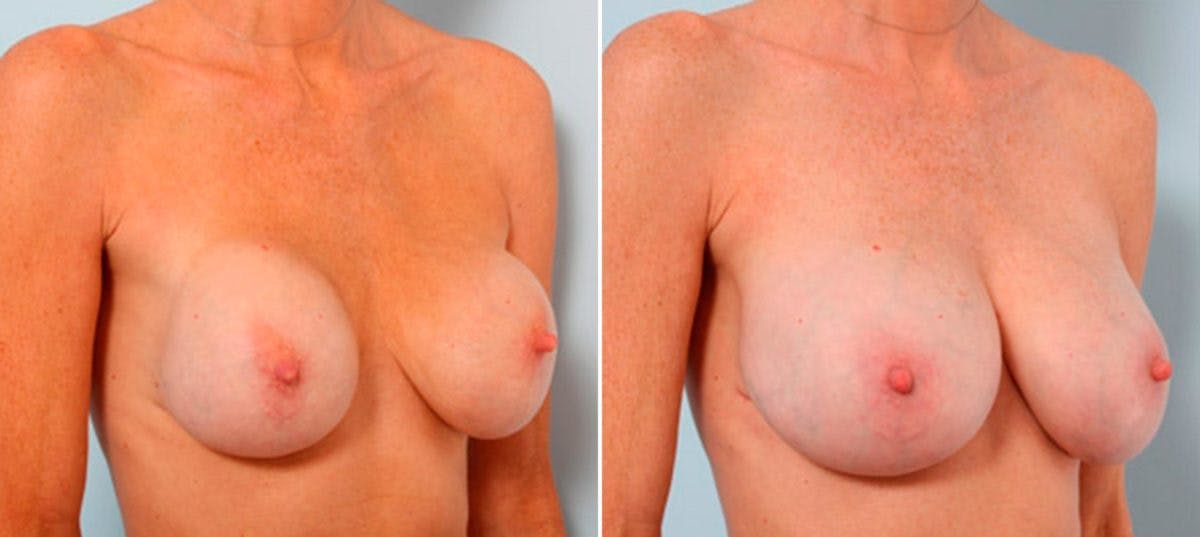 Breast Revision with Strattice Before & After Photo - Patient 54883347 - Image 3