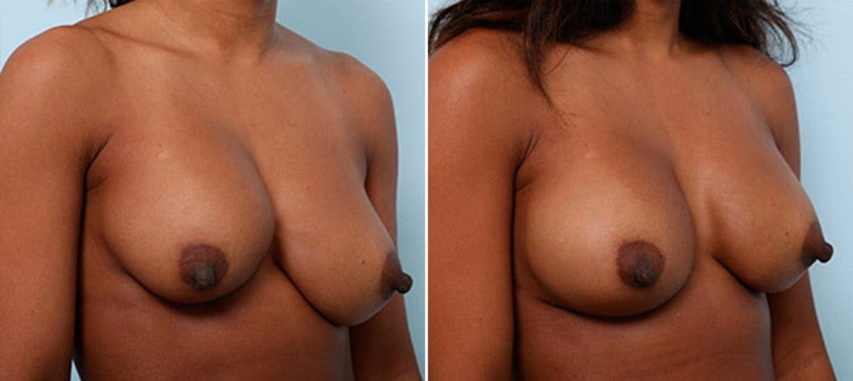 Breast Revision with Strattice Before & After Photo - Patient 54883350 - Image 2
