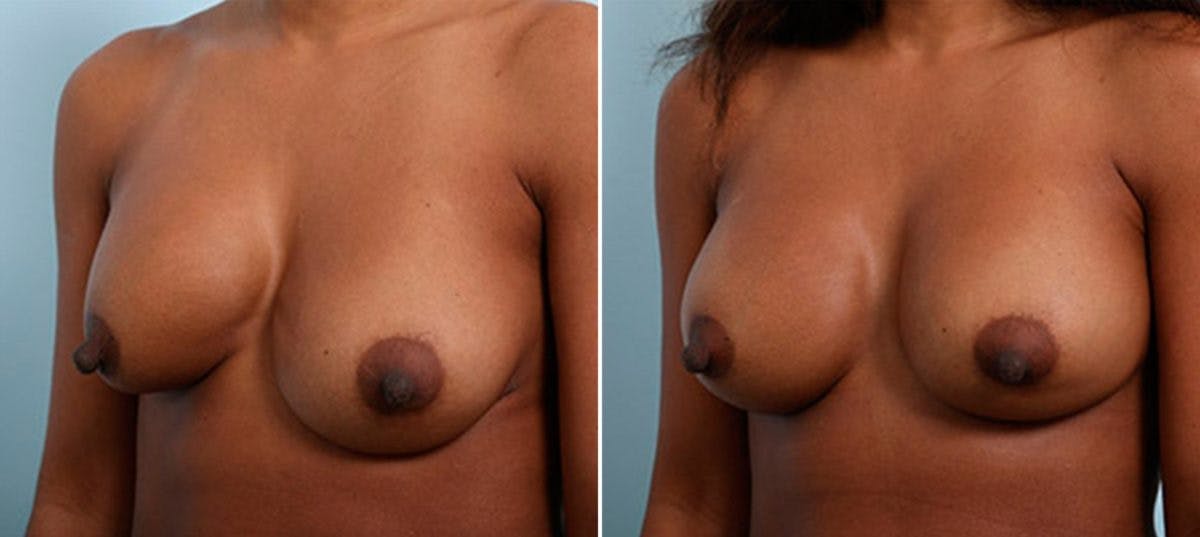 Breast Revision with Strattice Before & After Photo - Patient 54883350 - Image 4