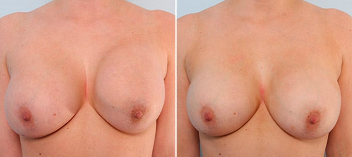 Breast Revision with Strattice Before & After Gallery - Patient 54883352 - Image 1