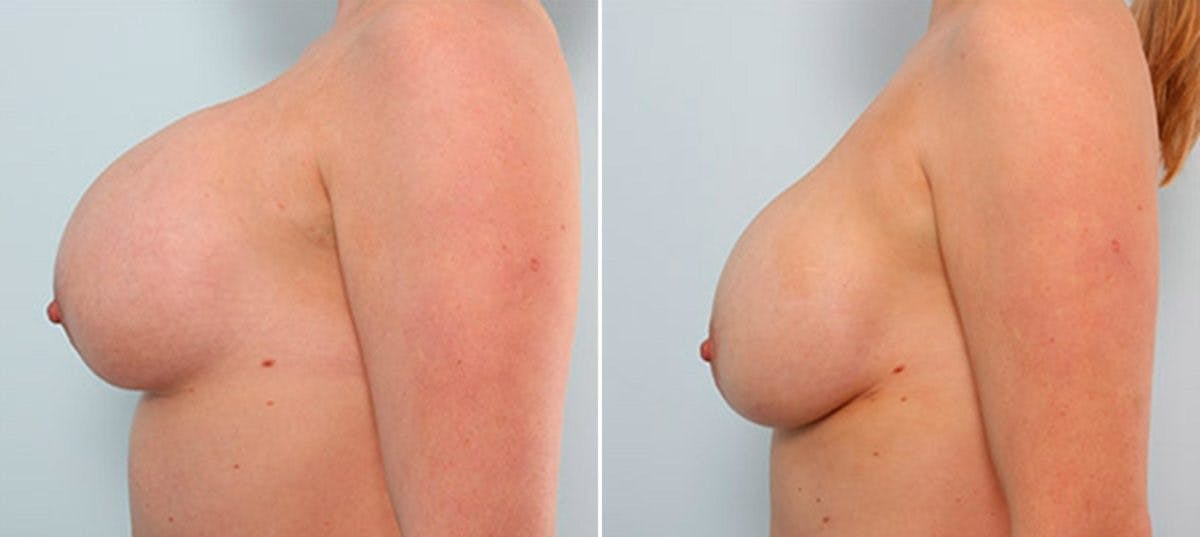 Breast Revision with Strattice Before & After Photo - Patient 54883352 - Image 5
