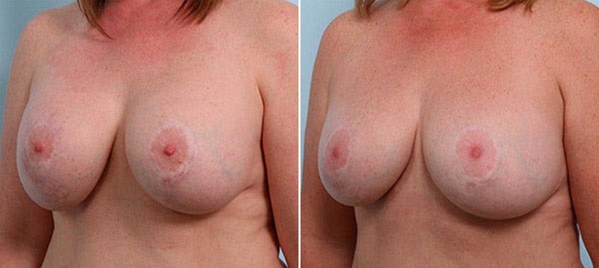 Breast Revision with Strattice Before & After Gallery - Patient 54883354 - Image 4